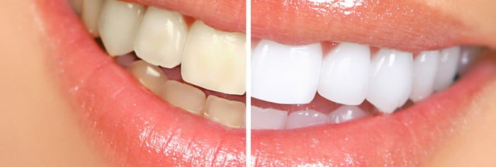  plano-odontológico-com-clareamento-dental