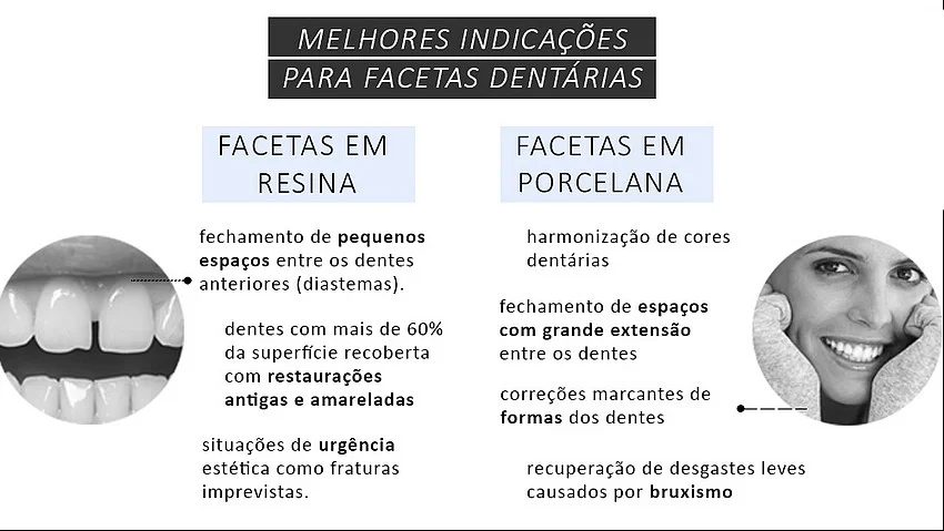 diferença-entre-facetas-em-resina-e-porcelana