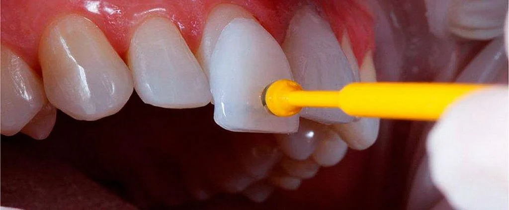 plano-dental-cobre-faceta-sem-carência