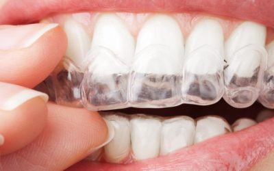 Valor da Placa de Bruxismo no Plano Dental, descubra aqui ! 0 (0)