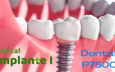 Dental P7500 e Dental Mais : Qual melhor plano com Implantes? 5 (1)